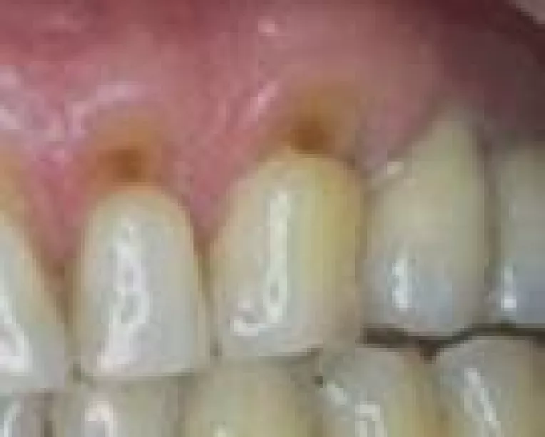 Carie tratata fara freza!