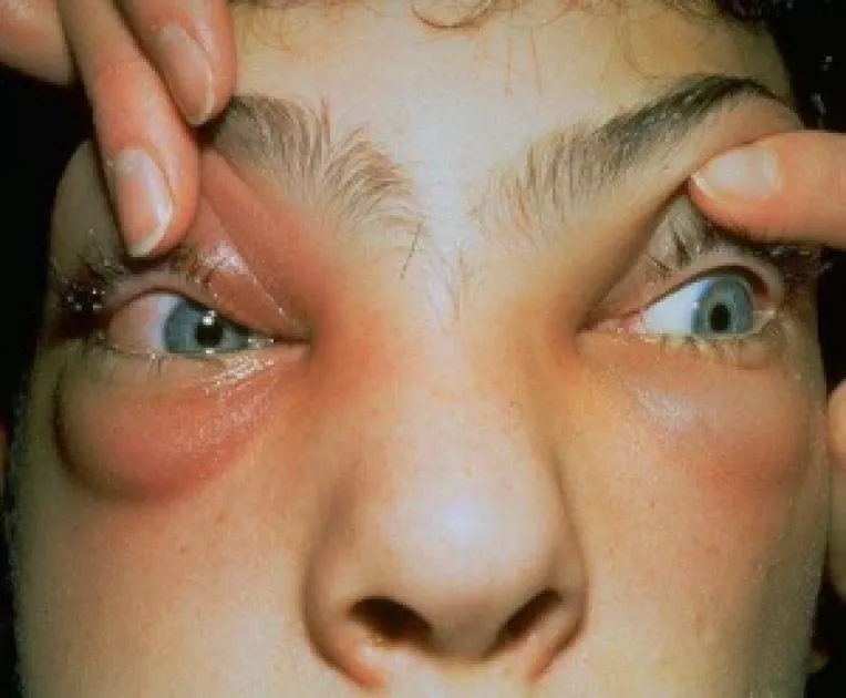 Conjunctivita poate fi cauzata de alergii, bacterii, virusuri sau substante toxice si este transmisibila