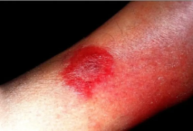 Erizipel, o infectie a pielii produsa de microbi