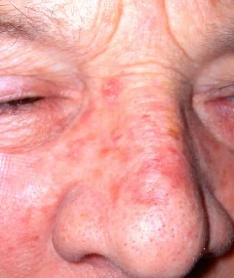 Keratoza actinica, leziune precanceroasa a pielii, cunoscuta si sub numele de keratoza solara (1)