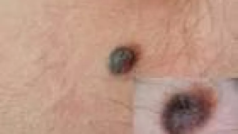 Melanomul malign, o grava problema