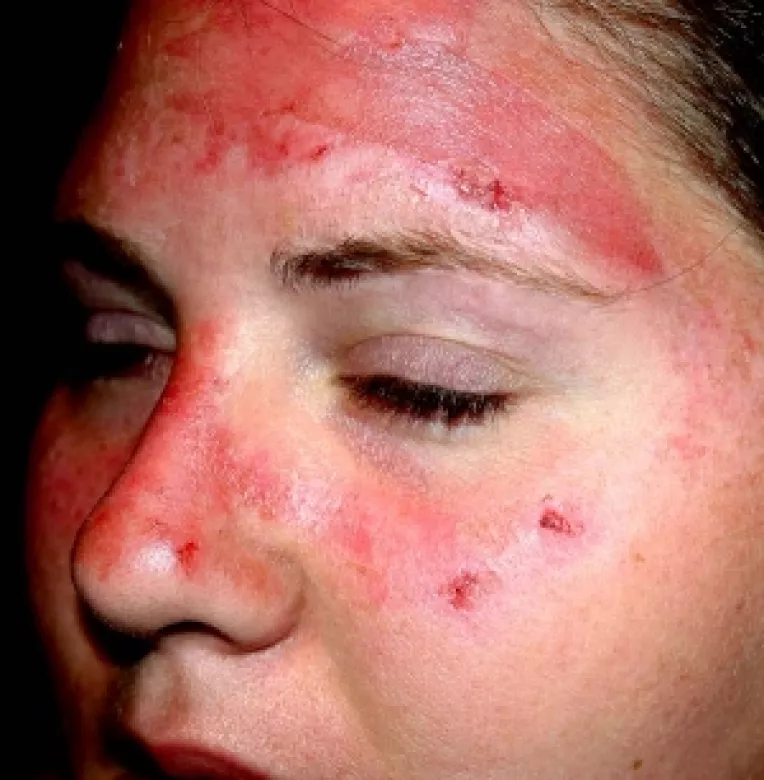 O tanara din Iasi a ajuns la spital cu arsuri grave, dupa ce a stat la plaja